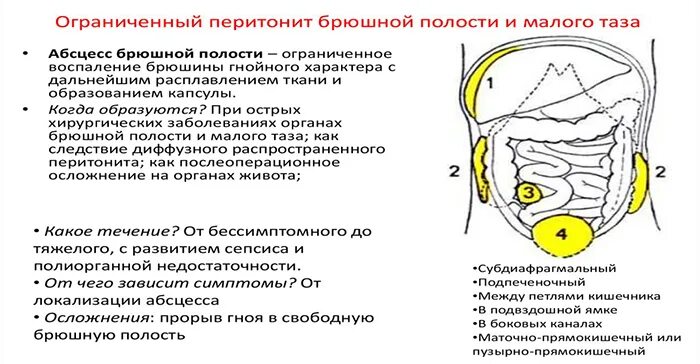 Локализация абсцессов брюшной полости. Пути распространения гноя в брюшной полости. Пути распространения экссудата в брюшной полости. Классификация послеоперационных абсцессов брюшной полости. Органы брюшной полости лечение