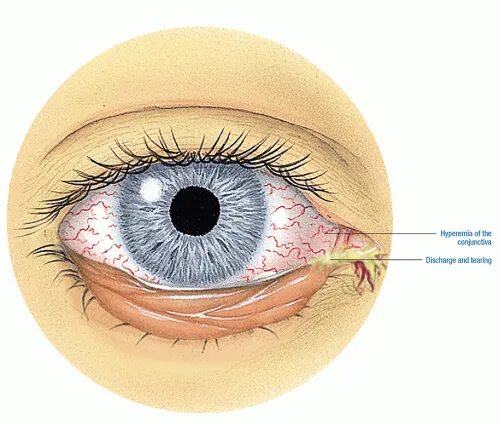 Конъюнктива ребенка. Лимбальный кератоконъюнктивит. Тарзальная конъюнктива. Кератит кератоконъюнктивит.