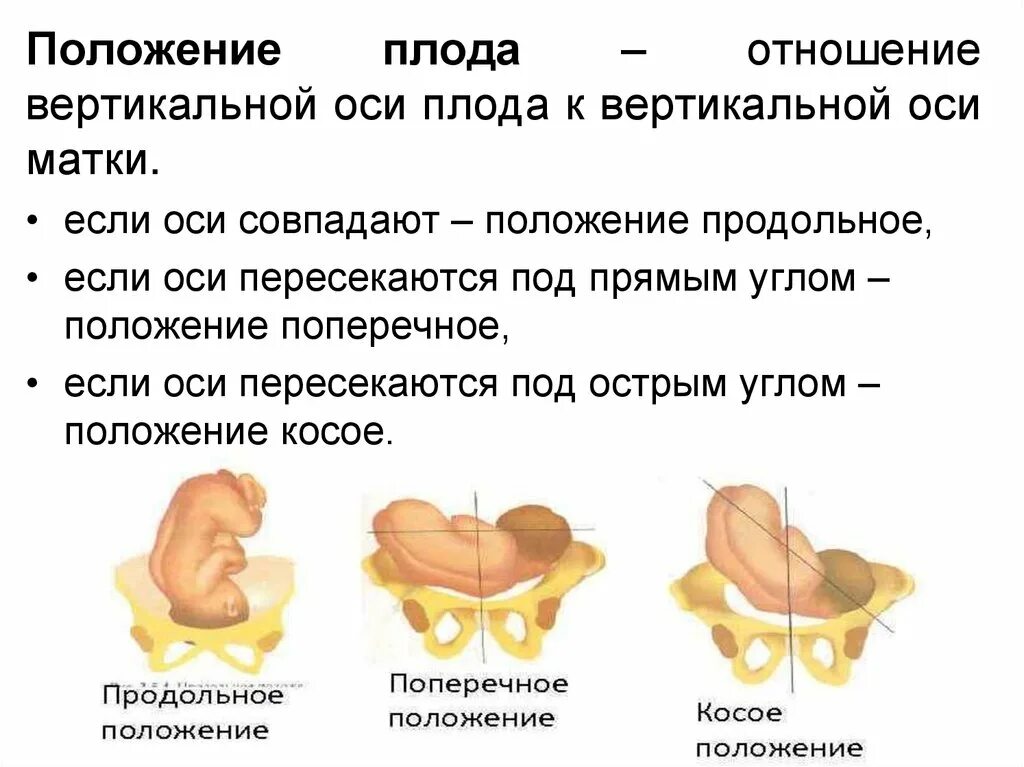 Положение позиция и вид плода. Неправильные позиции и положения плода. Позиции плода в акушерстве. Вид положения плода позиции плода. Положение плода в матке продольное