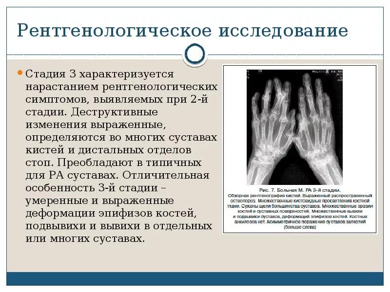 Артрит обследование. Рентгенодиагностика ревматоидного полиартрита. Ревматоидный артрит кисти рентген. Ревматоидный артрит кисти рентген стадии. Рентген стадии артрита кистей.