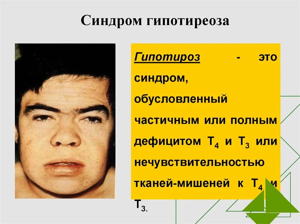 Врожденный гипотиреоз синдромы. Гипотиреоз внешние проявления. Синдромы при гипотиреозе. Синдром тельце