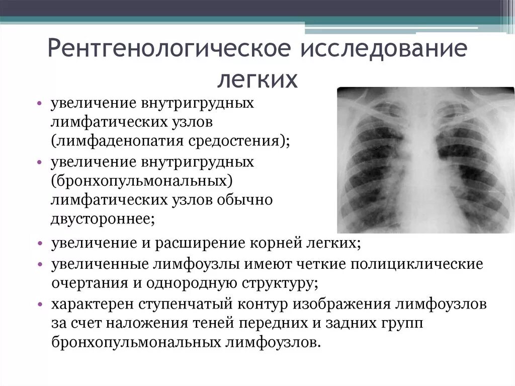 Легкие увеличен узел. Саркоидоз внутригрудных лимфоузлов рентген. Лимфаденопатия внутригрудных лимфоузлов рентген. Медиастинальная лимфаденопатия рентген. Увеличение внутригрудных лимфоузлов в легких рентген.
