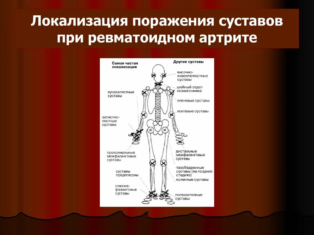 Боль в суставах при ревматоидном артрите. Локализация поражения суставов при ревматоидном артрите. Ревматоидный артрит суставной синдром. При ревматоидном артрите поражаются суставы. Локализация это.