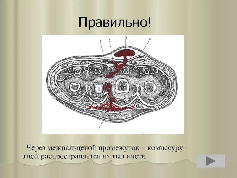 26 правильно. Межпальцевая (комиссуральная) флегмона. Комиссуральные флегмоны. Комиссуральные отверстия кисти.