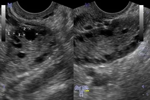 Кистозноизмененные яичники УЗИ. Мелкокистозная дегенерация яичников. Доминантный фолликул СПКЯ. Что значит изменение яичников