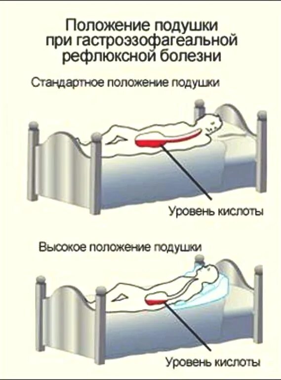 При рефлюксе на каком боку. Положение подушки при гастроэзофагеальной рефлюксной. Положение подушки при ГЭРБ. Положение кровати при ГЭРБ. Сон при ГЭРБ.