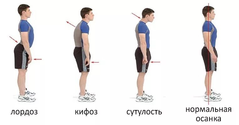 Осанка. Поясничный лордоз упражнения. Нормальная осанка человека. Сутулый Тип осанки.