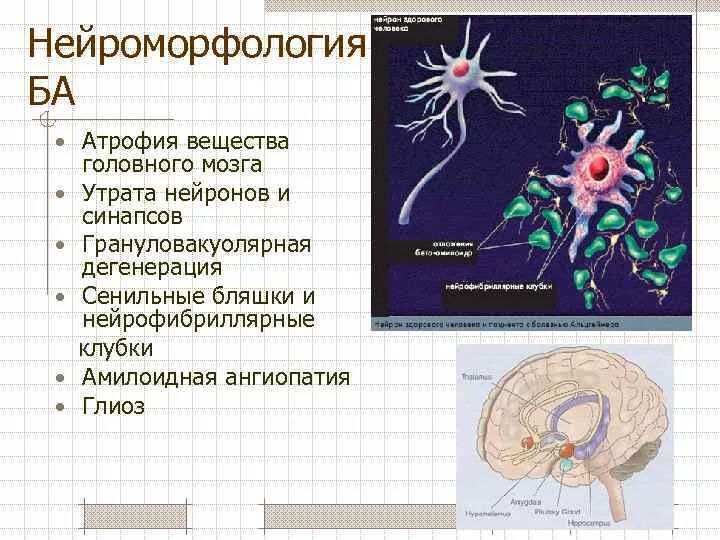 Нейроморфология мозга. Болезнь Альцгеймера Нейроны. Нейроны при болезни Альцгеймера.