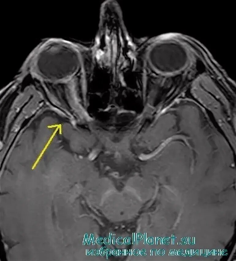 Мрт глазного нерва. Неврит зрительного нерва мрт. Неврит зрительного нерва кт. Атрофия зрительного нерва кт. Зрительный Перекрест мрт.
