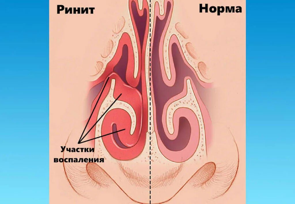 Хронический вазомотрныйринит. Хронический вазомоторный ринит.