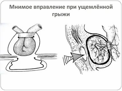 Ущемленная пупочная грыжа