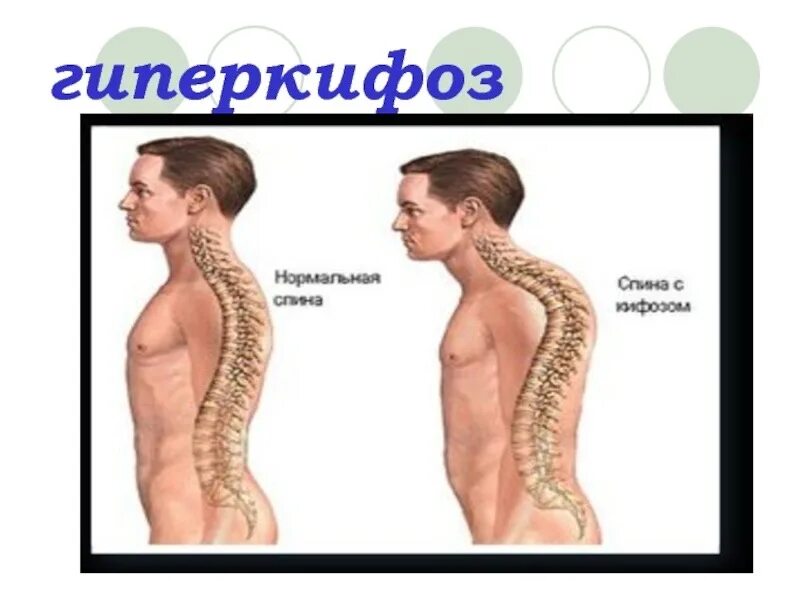 Кифоз грудного отдела позвоночника кифоз. Грудной гиперкифоз что это. Грудной гиперкифоз что это. Лордоз грудного отдела позвоночника. Гиперлордоз и гиперкифоз.