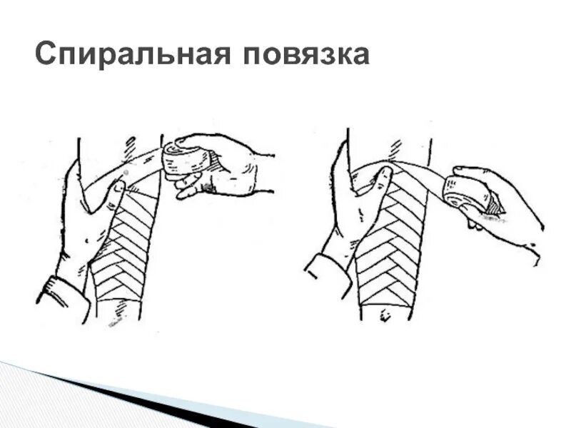 Спиральная повязка техника наложения