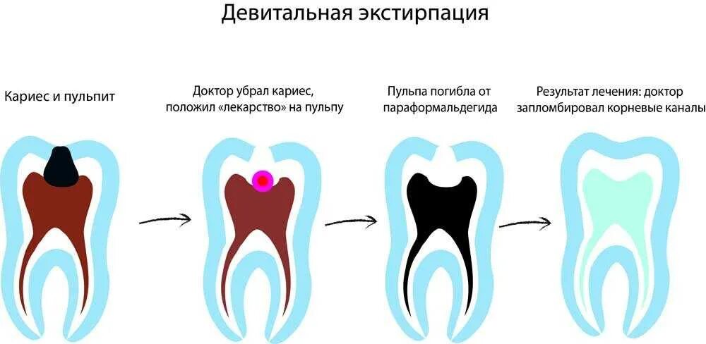 Витальная ампутация пульпы. Витальная экстирпация пульпы методика. Этапы лечения пульпита методом девитальная экстирпация зубов. Пульпит 1 .метод витальной экстирпации. Методы лечения пульпита девитальная экстирпация.