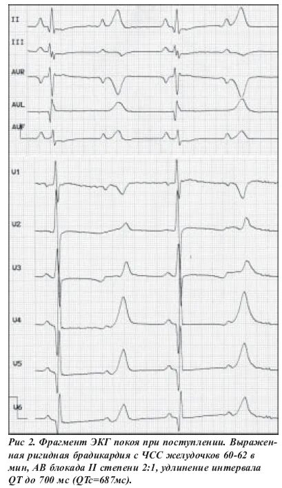 Удлиненный интервал qt на ЭКГ что это такое. Удлиненный qt интервал и брадикардия. Удлинение интервала qt у ребенка до года. Удлиненное qt у ребенка