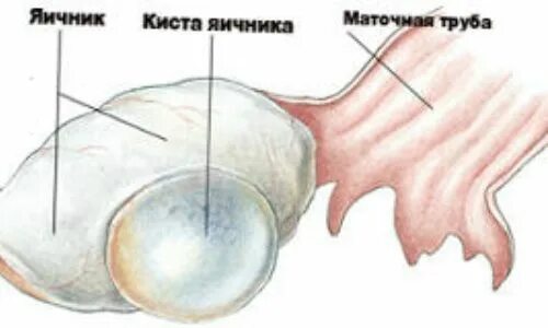 Цилиоэпителиальная киста яичника. Перилигаментозная киста. Доброкачественная киста яичника.