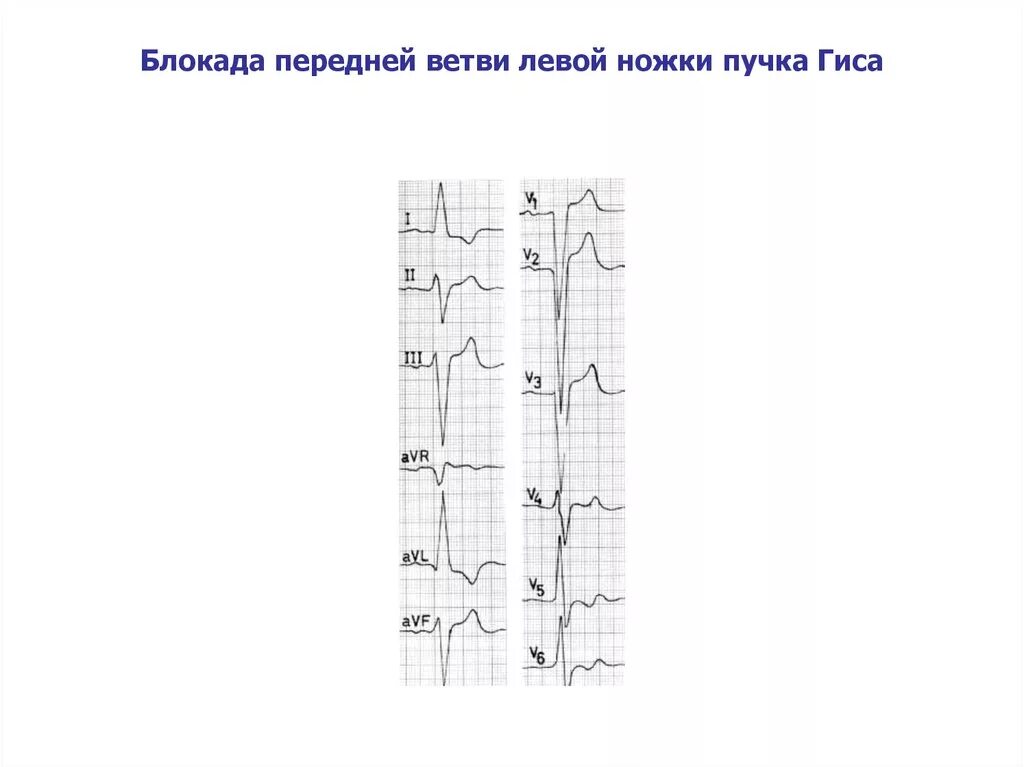 Неполная блокада ножек и ветвей пучка гиса