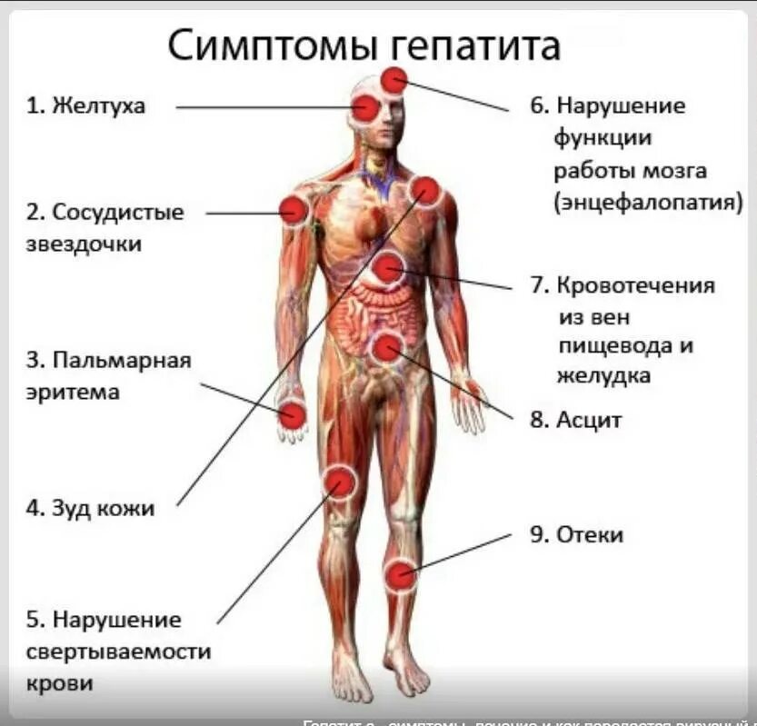 Клинические симптомы гепатита б. Вирусный гепатит симптомы. Симптомы гепатита в с симптомы.