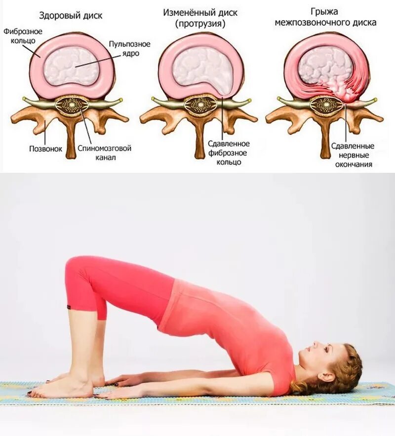 Протрузии дисков пояснично-крестцового отдела. Гимнастика при протрузии межпозвонковых дисков поясничного отдела. Протрузия поясничного отдела позвоночника. Гимнастика для грыжи и протрузии.