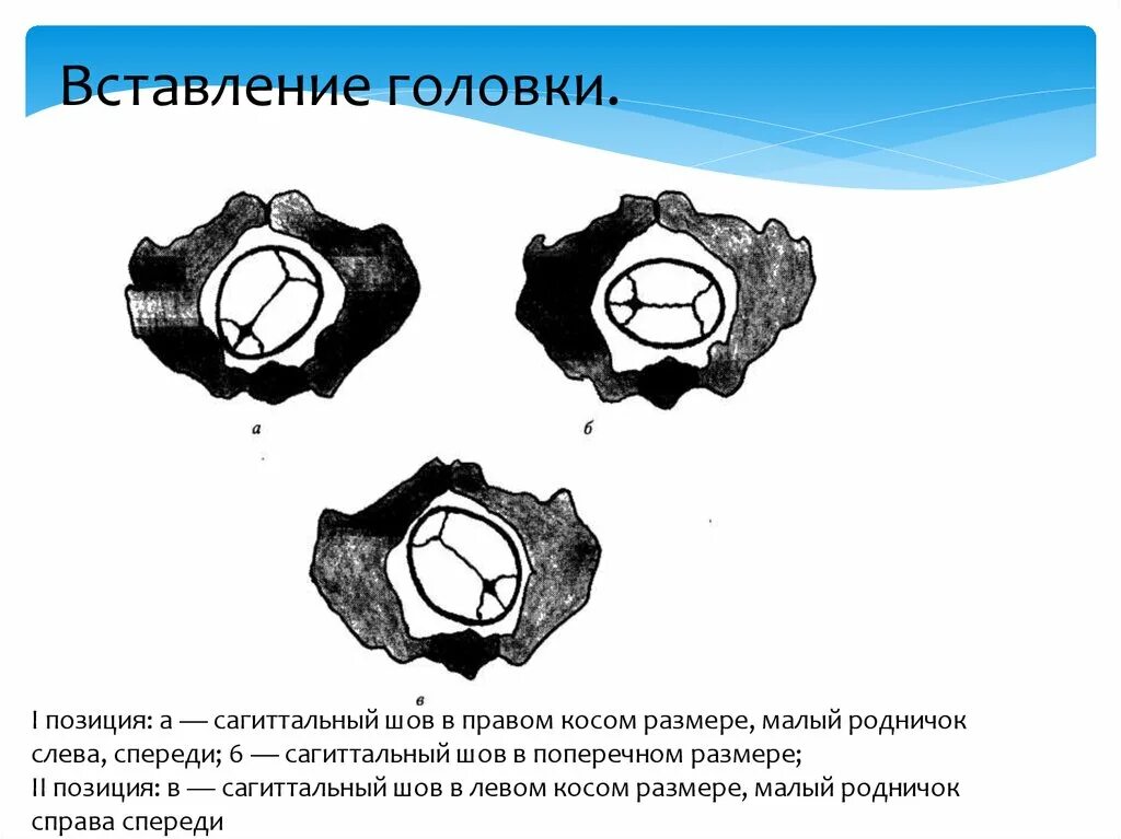 Как определить в каком положении находится. Стреловидный шов вид и позиция. Правый косой размер головки. Стреловидный шов в правом косом размере. Позиция плода и стреловидный шов.