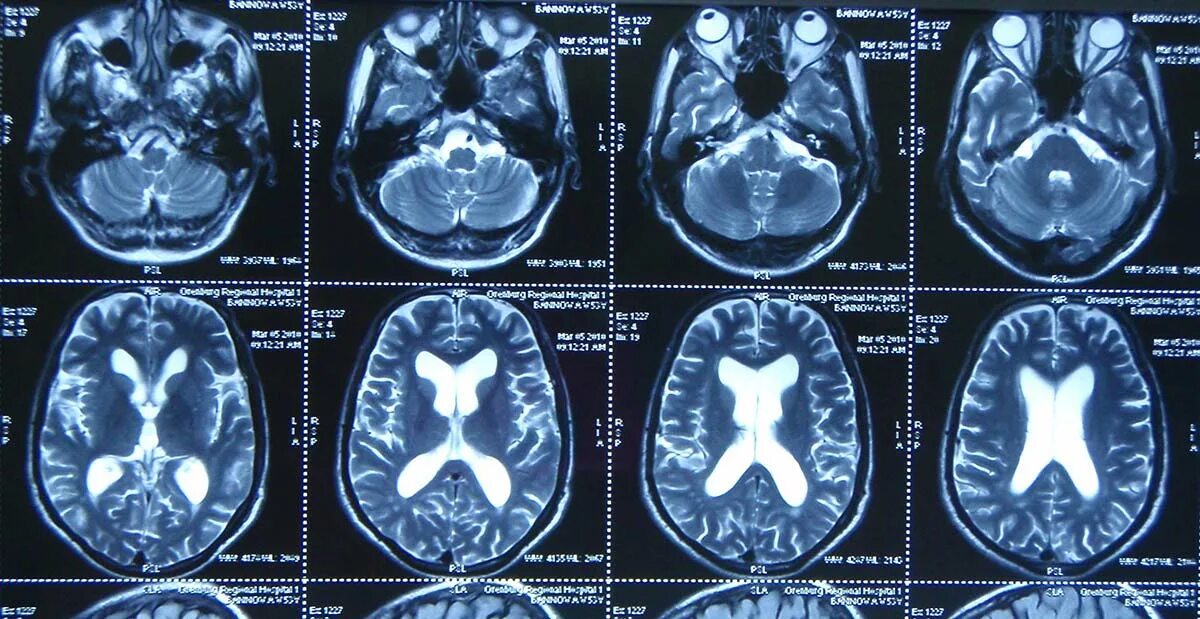 Мрт головного мозга. Снимки мрт головного мозга. Кт головного мозга снимки. Мрт снимок.