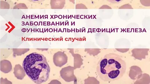 Анемия хронических состояний
