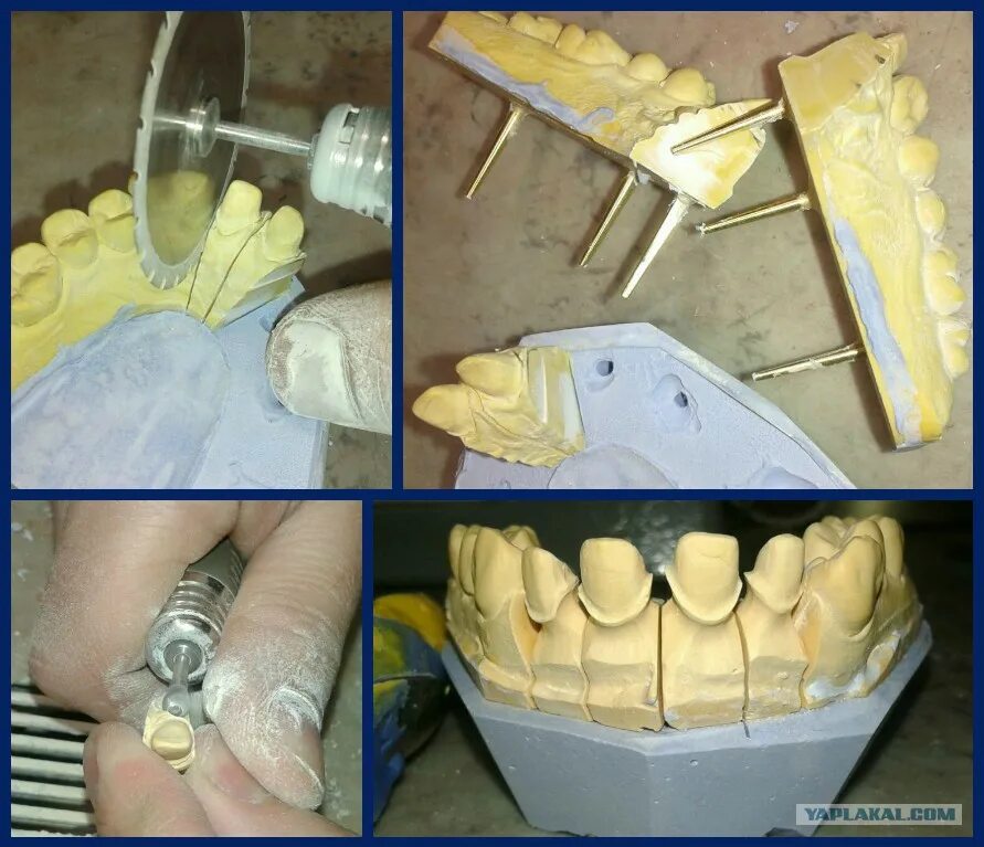 Изготовление гипсовой модели. Разборная модель. Разборная гипсовая модель. Штифтовая разборная модель. Гипсовая модель зубов.
