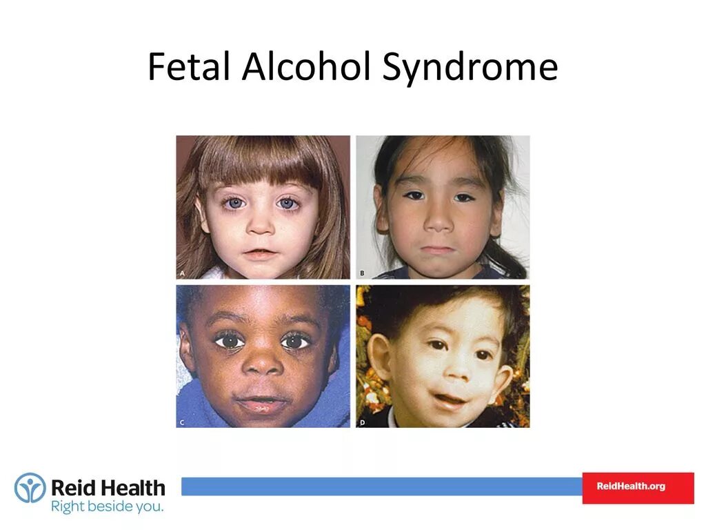 Алкогольный синдром у взрослых. Фетально алкогольный синдром. Фетальный алкогольный синдром у детей. ФАС алкогольный синдром у детей. Фетальный алкогольный синдром у Натальи Водяновой.