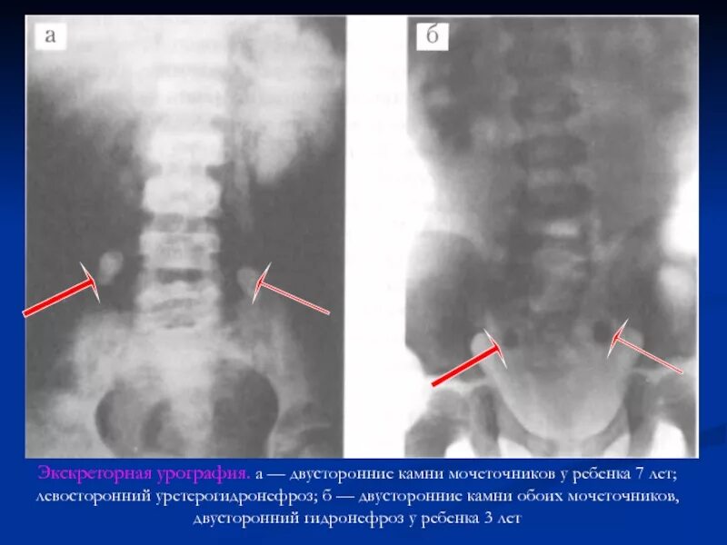 Рентген мочеточника. Обзорная урограмма мочекаменная болезнь. Мочекаменная болезнь экскреторная урография. Экскреторная урография гидронефроз снимки. Экскреторная урография почек рентген.