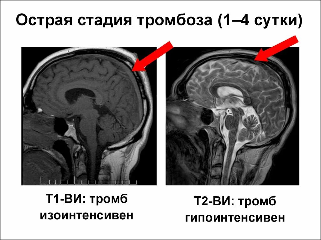 Тромбоз кавернозного синуса на кт. Тромбоз синусов головного мозга кт. Тромбоз пещеристого синуса кт. Тромбоз поперечного синуса кт. Церебрального тромбоза