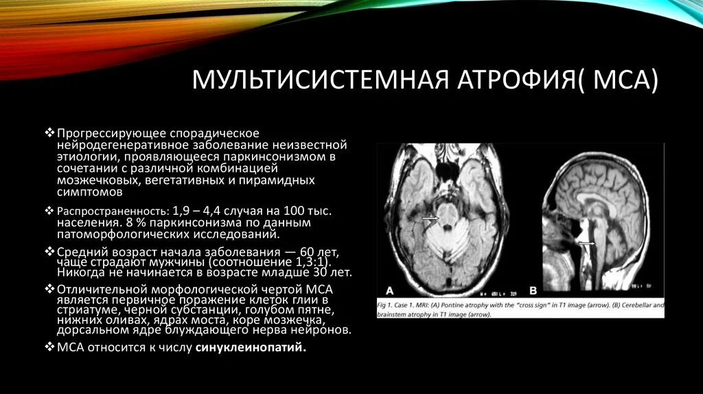 Мультисистемная атрофия клинические рекомендации. Мультисистемная атрофия головного мозга. Мрт при мультисистемной атрофии. Мультисистемная атрофия головного мозга на мрт. Атрофия головного мозга 1