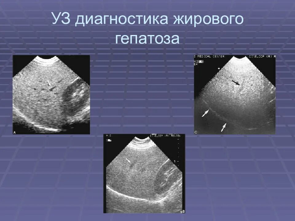 Диффузные изменения печени жировой гепатоз что это. Жировой гепатоз печени на УЗИ. Жировая инфильтрация печени на УЗИ. Жировой гепатоз УЗИ картина.