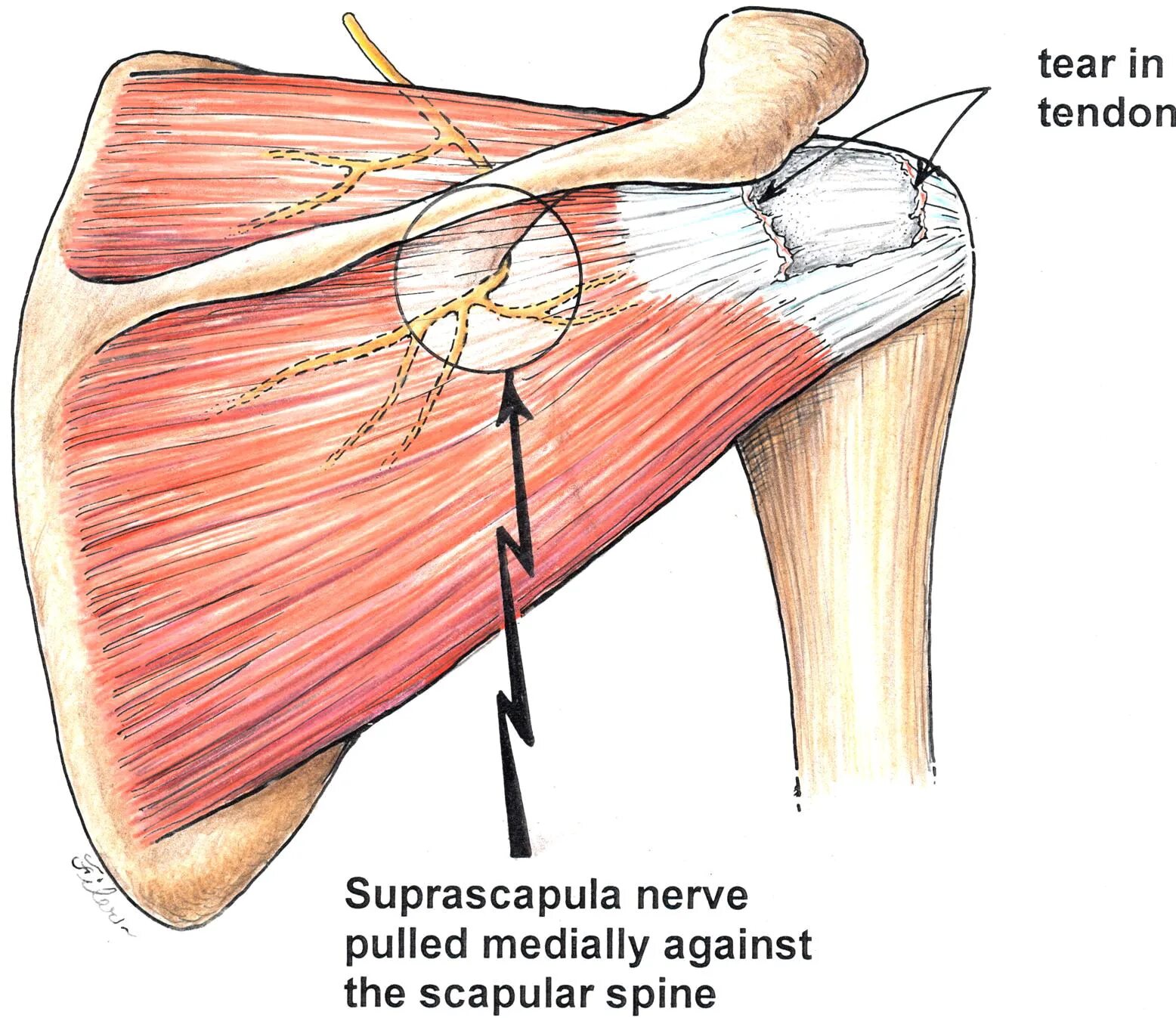 Сухожилие животных. N suprascapularis. Невропатия suprascapularis. Надлопаточный нерв анатомия. *М. infraspinatus.
