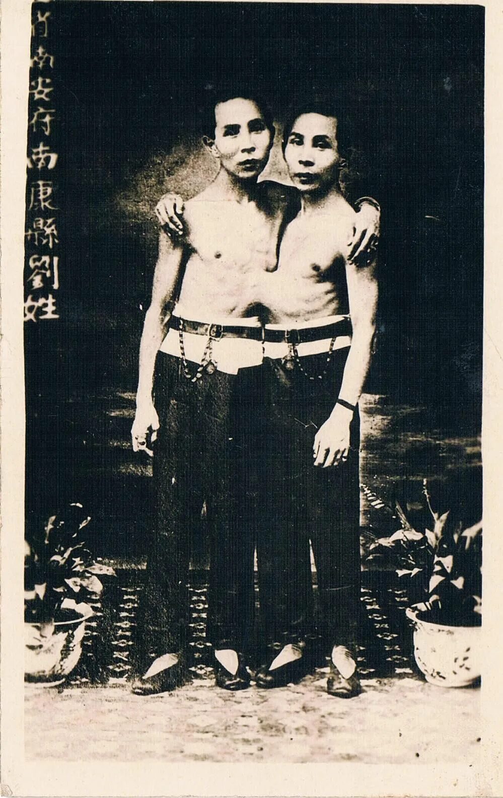 Сиамские близнецы чанг. Сиамские Близнецы 1811 год Сиам. Сиамские Близнецы Банкеры. Чанг Банкер.