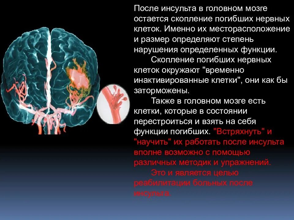 Инсульт. Головной мозг после инсульта. Головной мозг после ишемического инсульта.