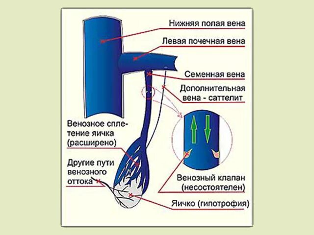 Расширение семенной вены. Венозный отток от яичка. Расширение вен семенного канатика.