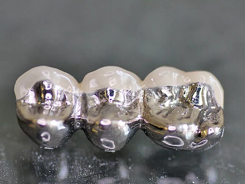 Комбинированные зубы. Мостовидный протез железный. Цельнолитая коронка (кхс с напылением). Коронка цельнолитая (никель хром). Несъёмный мостовидный протез челюсти.