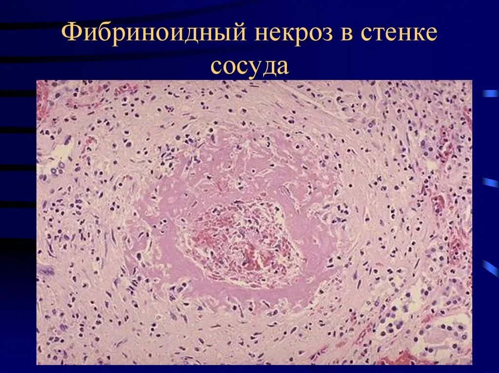 Патанат. Фибриноидный некроз сосудов. некроз и апоптоз патологическая анатомия. фибриноидный некроз патанатомия. фибриноидное набухание микропрепарат.