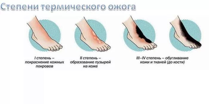 При термическом ожоге третьей степени. Клинические проявления термического ожога 3 степени. 4 Степень термических ожогов. Симптомы при термическом ожоге 1 степени. Укажите клинические проявления термических ожогов 3 степени.