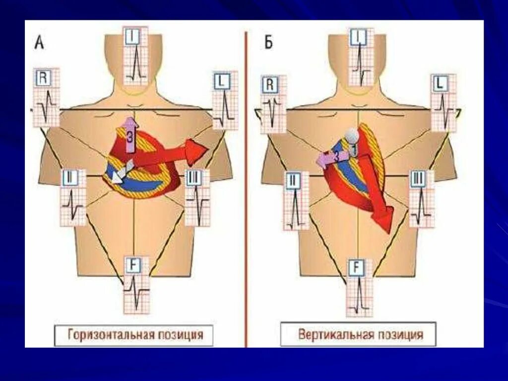 Вертикальная позиция сердца. Горизонтальное расположение сердца. Вертикальная электрическая позиция сердца. Горизонтальное положение сердца. Вертикальное расположение сердца.