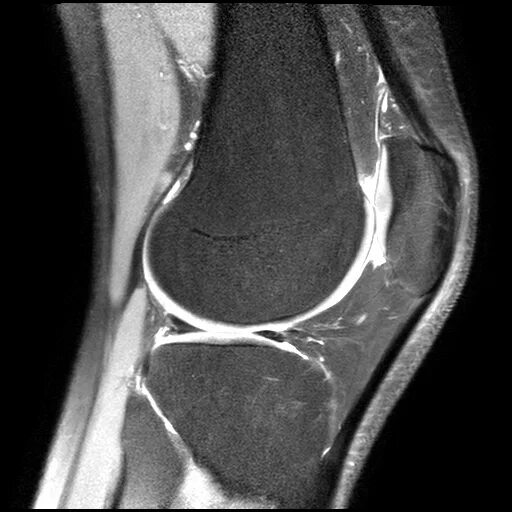 Хондромаляция надколенника мрт. Хондромаляция надколенника на кт. Мрт мениска коленного сустава. Хондромаляция колена кт.