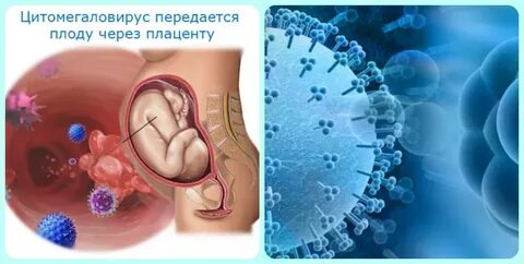 Цитомегаловирусная инфекция у беременных