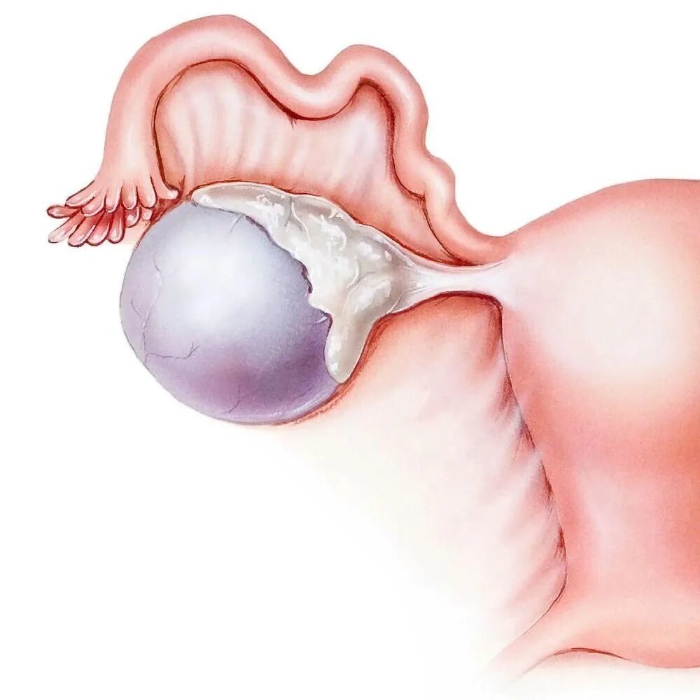 Ретенционные кисты яичника. Ретенционная киста яичников. Киста яичника гинекология. Доброкачественная киста яичника.