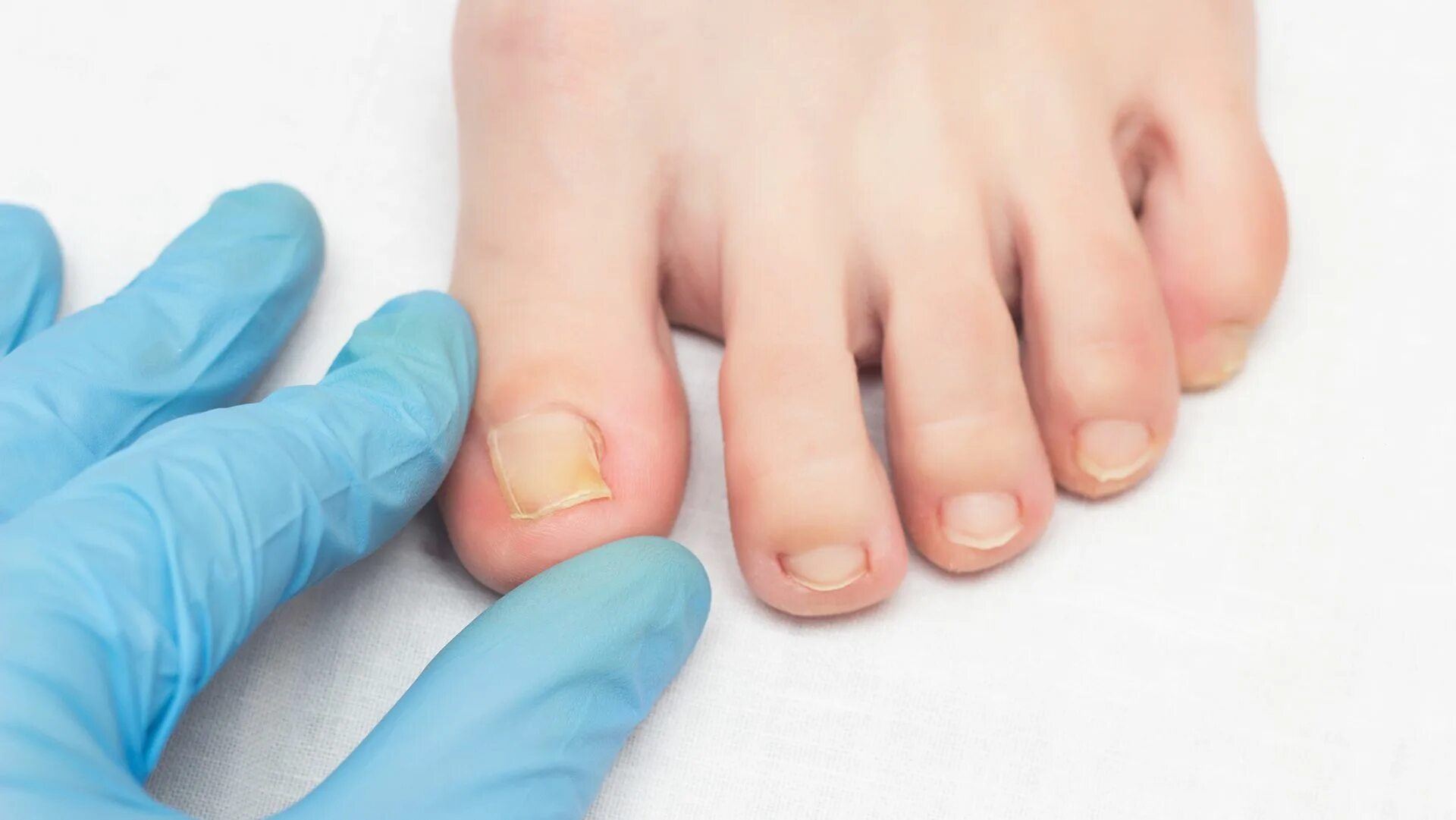 Врач лечение ногтей на ногах. Онихомикоз онихокриптоз. Вросший ноготь на большом пальце ноги.