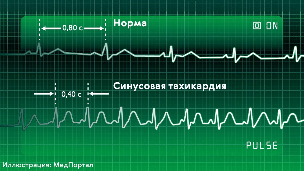 Сон сильное сердцебиение. Тахикардия фото. Кардиограмма при высоком пульсе. Пульс при тахикардии. Усиленное сердцебиение.