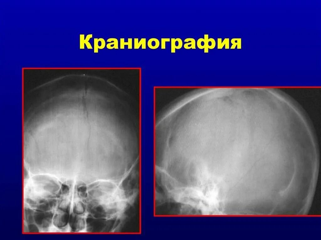 Кости черепа рентген. Кости черепа рентген норма. Рентгенография черепа (краниография. Рентген черепа в боковой проекции. Краниография боковая проекция.