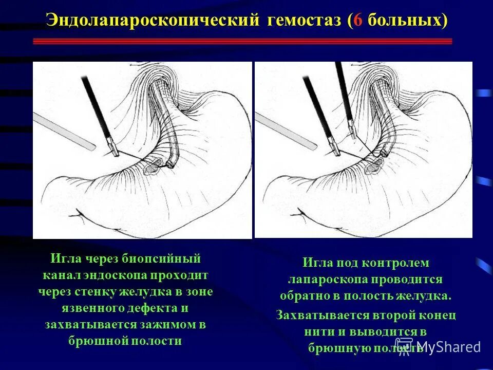 Что больная игла