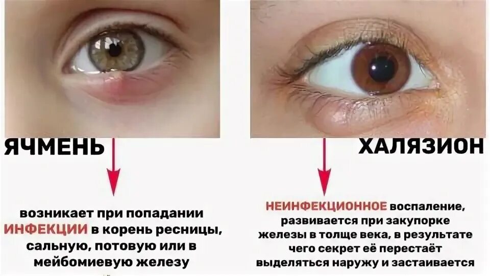 Ячмень из за чего. Ячмень из за чего