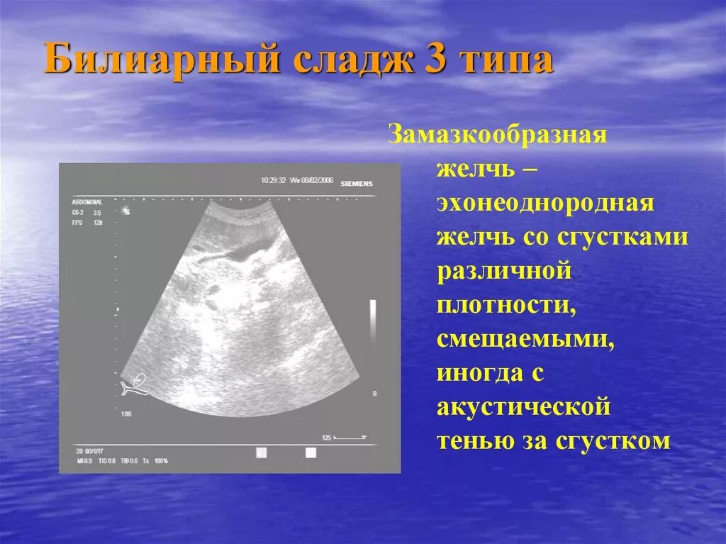 Сгустки в желчном пузыре. Сладж в желчном пузыре УЗИ. УЗИ сладж синдром желчный. Сладж желчи желчного пузыря на УЗИ. Сладж-синдром желчного пузыря на УЗИ.