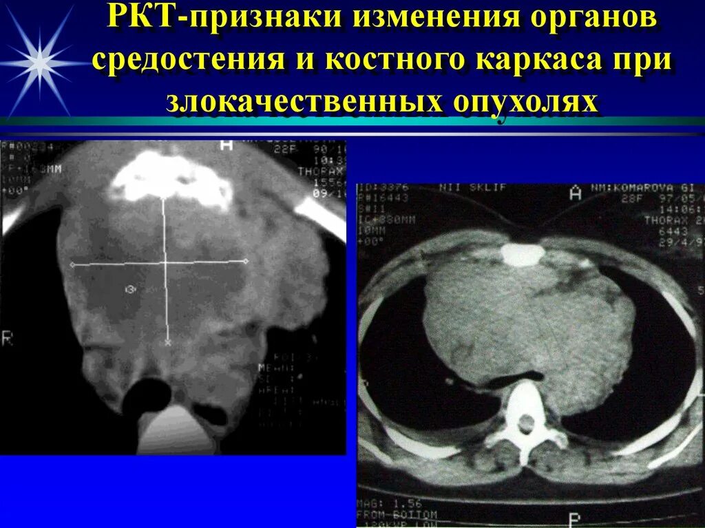 Что такое ркт. Рентгеновская компьютерная томография (РКТ). Злокачественная опухоль на кт. Кт органов грудной клетки и средостения.